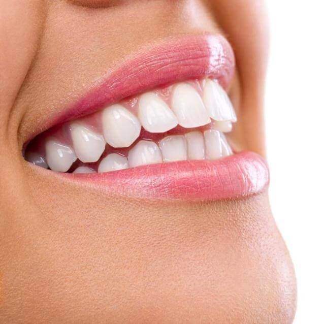 MY INVISALIGN JOURNEY – PART 1 – MEASURING UP FOR ALIGNERS