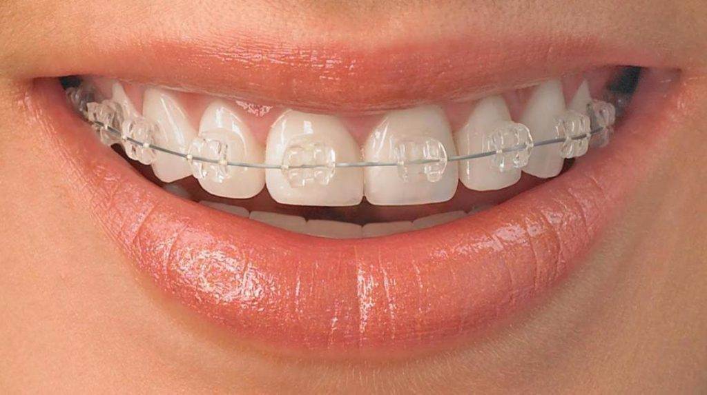 5 HABITS THAT MAKE LIVING WITH BRACES EASIER