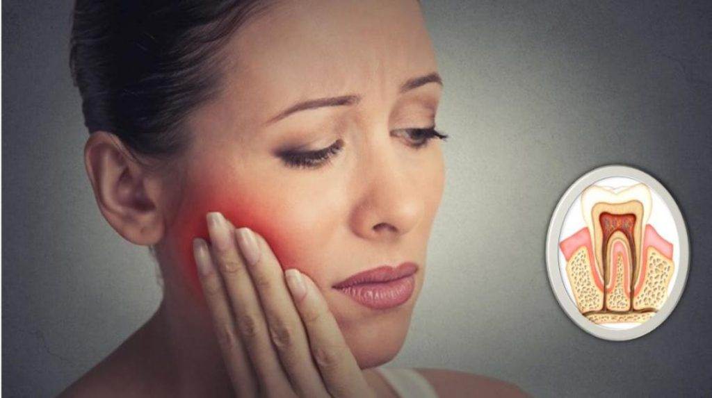 5 Signs You Need a Root Canal Treatment